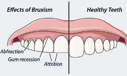 help for bruxism and grinding in ottawa