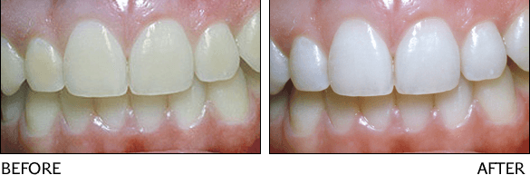 ottawa teeth whitening