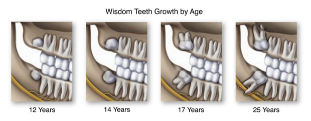 wisdom teeth extraction ottawa dental office