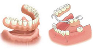 dentures and partials ottawa ontario dentist