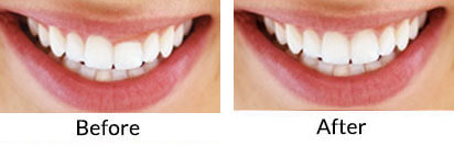 Laser Gum Contouring - Thornhill, Vaughan, Richmond Hill Dentist