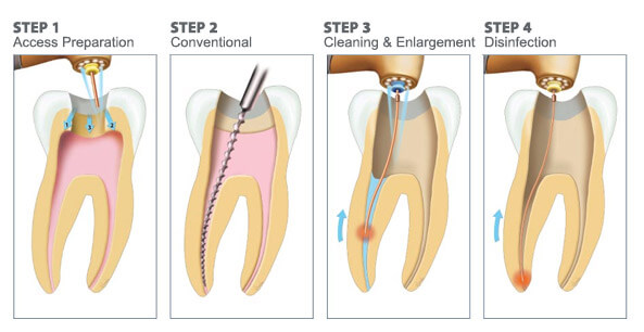 dental root canal therapy dr doumit
