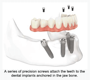 Dental Implants Ottawa  Implant Dentistry Ottawa