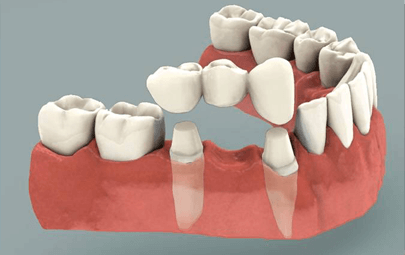 dental crowns and bridges ottawa dentist