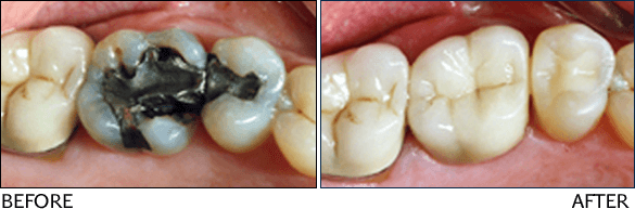 dental crowns and bridges ottawa dentist