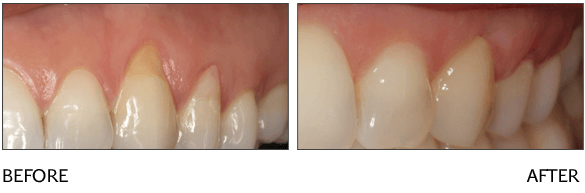 gum tissue grafting ottawa dentist