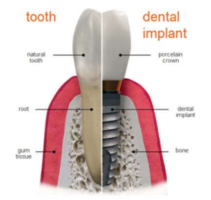 cheap dental implants cost ottawa