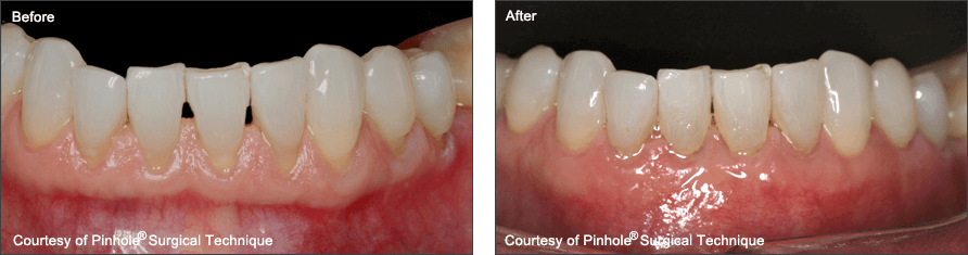 gum recession treatment