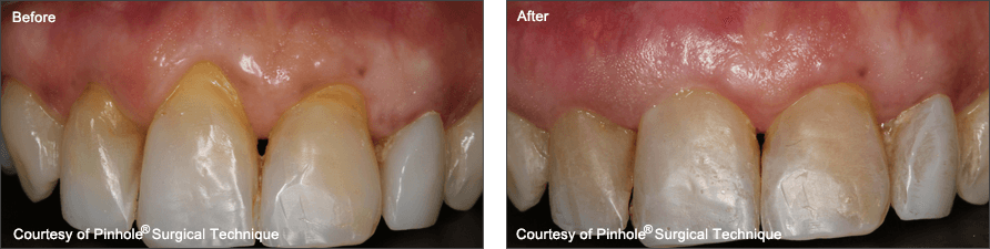 gum rejuvenation