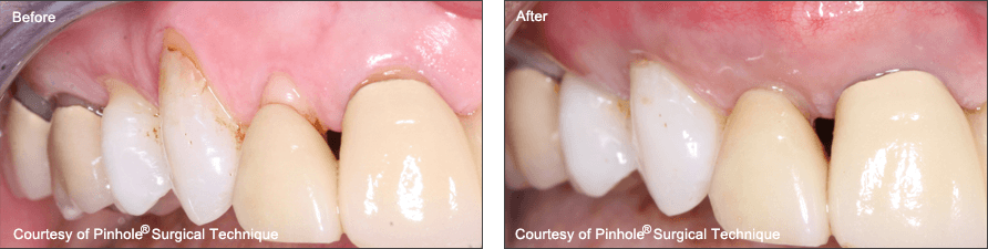 pinhole surgery