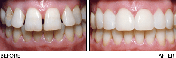 ottawa porcelain veneers