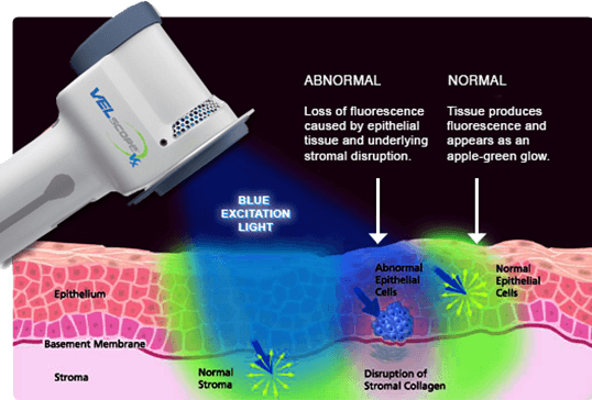 Velscope cancer screening